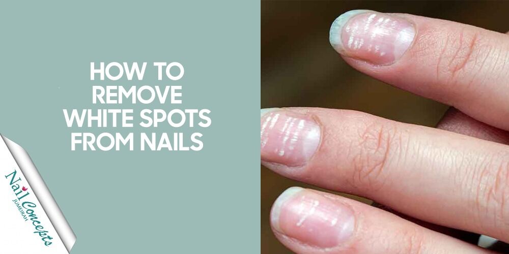 How to Get Rid of White Spots on Nails